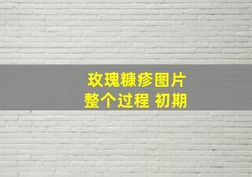 玫瑰糠疹图片整个过程 初期